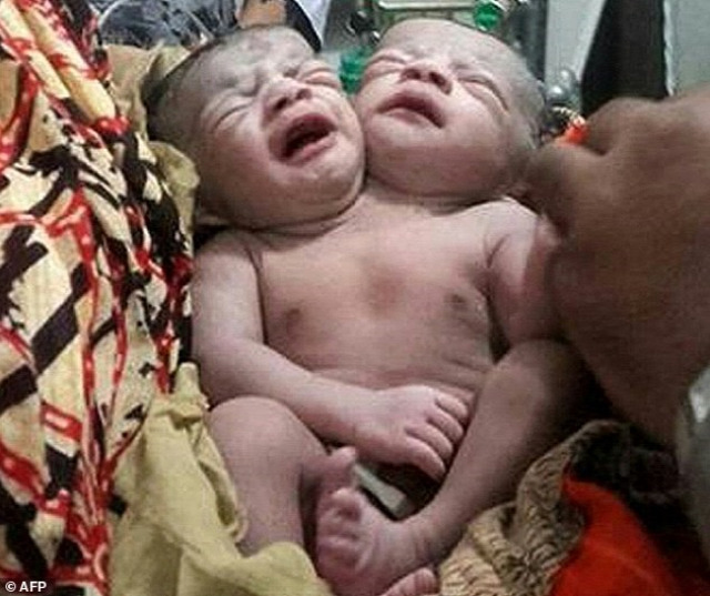 kétfejű sziámi ikrek csecsemő újszülött