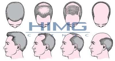 hajbeültetés hajátültetés fue fue hajbeültetés kopaszodás hajhullás hajvesztés megoldás kopaszodásra hajbeültetés blog hajbeültetés eredmény férfias kopaszodás kopaszodás okai női kopaszodás férfi hajhullás férfia kopaszodás kopaszodás probléma hajbeültetés férfiaknak férfi hajvesztés kopasz felület kopasz forgó kopasz folt kopasz fej paróka