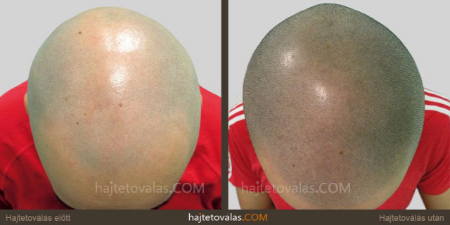 hajtetoválás mikro pigmentáció mikropigmentáció fejbőr tetoválás haj pigmentáció  hajpigmentáció orvosi pigmentáció orvosi tetoválás kopaszodás hajhullás hajtetoválás eredmény hajtetoválás eredménye hajtetoválás eredmények hajtetoválás képek hajtetoválás után hajtetoválás előtt után