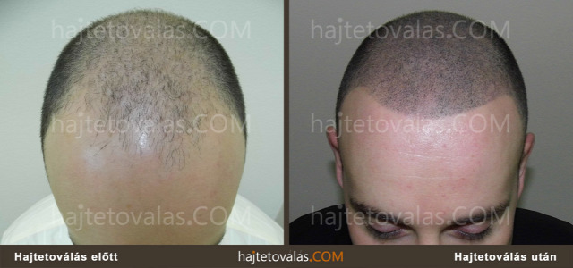 hajtetoválás mikropigmentáció fejbőr tetoválás fejtetoválás orvosi pigmentáció hajpigmentáció hajhullás ritka haj ritkás haj  kopaszodás férfias kopaszodás női kopaszodás megoldás kopaszodásra hajtetoválás eredmények hajtetoválás kinek hajtetoválás előnyök hajtetoválás módszer hajtetoválásról