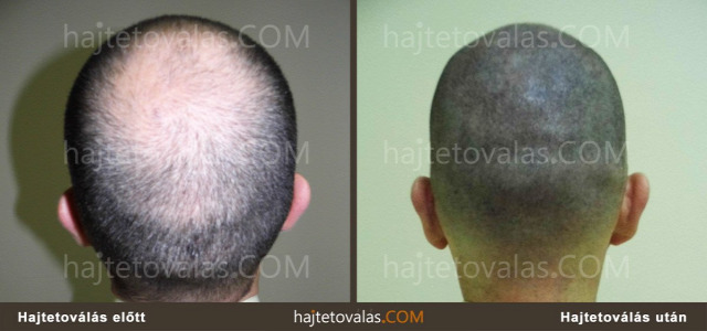 hajtetoválás mikropigmentáció fejbőr tetoválás fejtetoválás orvosi pigmentáció hajpigmentáció hajhullás ritka haj ritkás haj  kopaszodás férfias kopaszodás női kopaszodás megoldás kopaszodásra hajtetoválás eredmények hajtetoválás kinek hajtetoválás előnyök hajtetoválás módszer hajtetoválásról
