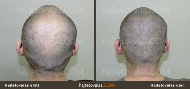 hajtetoválás mikro pigmentáció mikropigmentáció fejbőr tetoválás haj pigmentáció  hajpigmentáció orvosi pigmentáció orvosi tetoválás kopaszodás hajhullás hajtetoválás eredmény hajtetoválás eredménye hajtetoválás eredmények hajtetoválás képek hajtetoválás után hajtetoválás előtt után