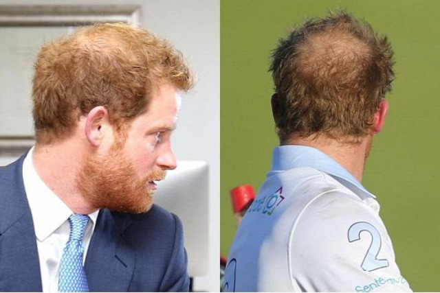 hajhullás kopaszodás genetika öröklött kopaszodás harry herceg vilmos herceg család királyi család hajátültetés hajbeültetés hairhungary
