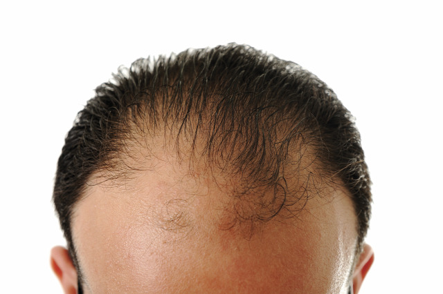 hajhullás kopaszodás androgén hajhullás genetika öröklött kopaszodás végleges kopaszodás hajátültetés hajbeültetés prp kezelés hajkezelés hajterápia hairhungary