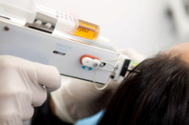 hajhullás hairhungary klinika hairhungary mezoterápia kezelés hajkezelés hatóanyag injekció mezo-pisztoly hajátültetés follione