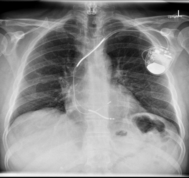 pacemaker elem napelem
