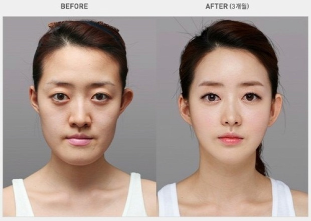 A világ érdekes Dél-Korea plasztikai műtét