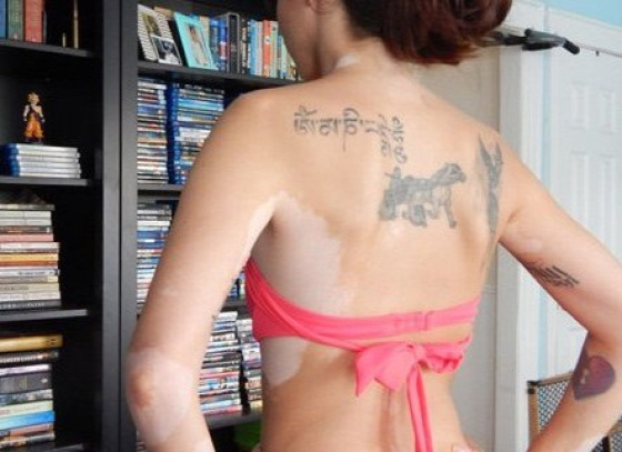 vitiligo tetoválás tetkó