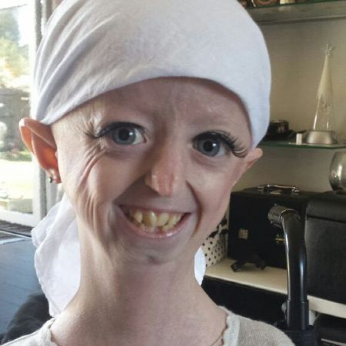 betegség test progeria halszag szindróma kőember faember vámpír vérfarkas korai öregedés ritka betegség