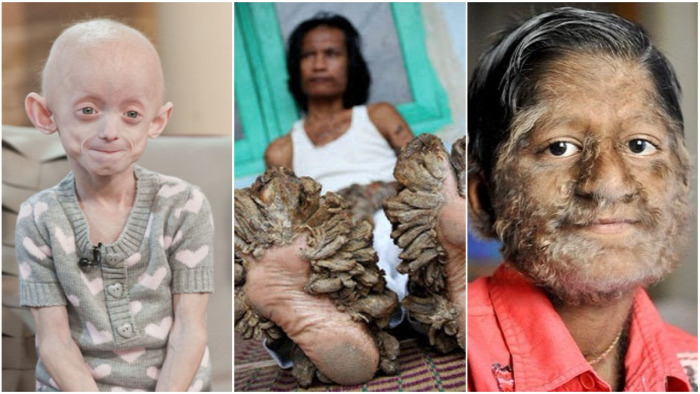 betegség test progeria halszag szindróma kőember faember vámpír vérfarkas korai öregedés ritka betegség