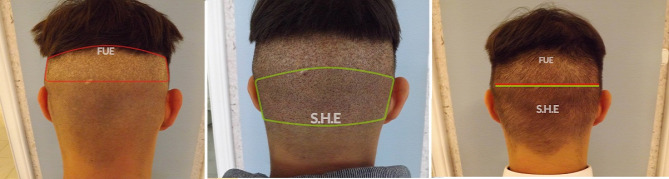 hajbeültetés hajátültetés hajbeültetés története hajátültetés története hajbeültetés módszer hajbeültetés módszerek hajátültetés módszer hajátültetés módszerek FUT hajbeültetés FUE hajbeültetés S.H.E. hajbeültetés