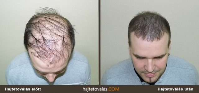 hajtetoválás haj pigmentáció orvosi pigmentáció trichopigmentáció hajtetoválás előtt hajtetoválás után hajtetoválás eredmény haj pigmentáció eredmény hajtetoválás kép  hajtetoválás képek  hajtetoválás ár hajtetoválás fotó