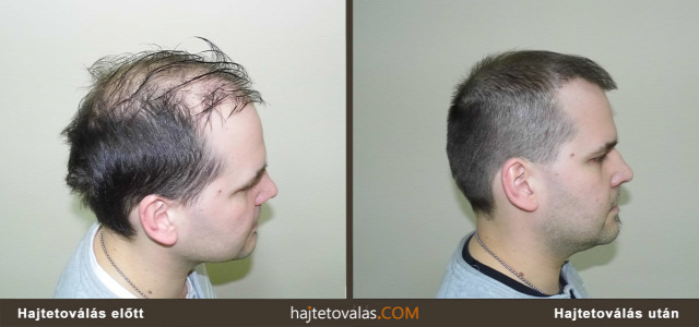 hajtetoválás haj pigmentáció orvosi pigmentáció trichopigmentáció hajtetoválás előtt hajtetoválás után hajtetoválás eredmény haj pigmentáció eredmény hajtetoválás kép  hajtetoválás képek  hajtetoválás ár hajtetoválás fotó