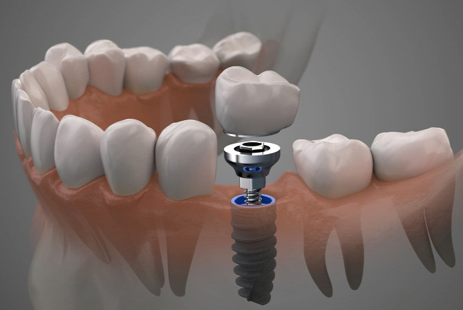 How dental implants help you?
