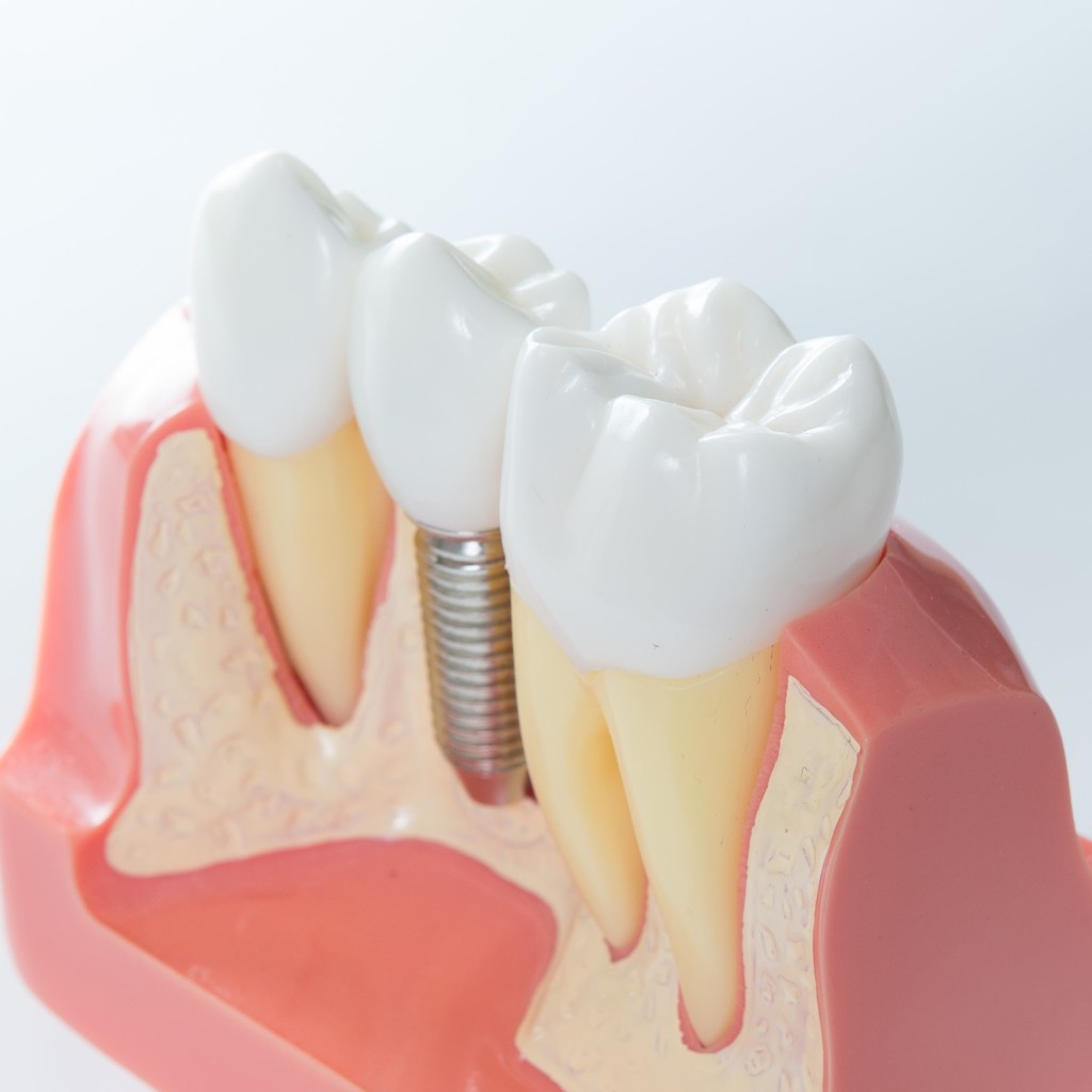 Dentist implants