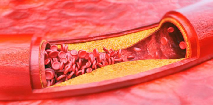 egészség érelmeszesedés érszűkület koleszterin szívinfarktus
