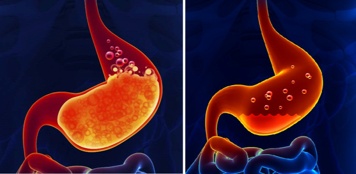 egészség táplálkozás gyomorsav reflux Crohn-betegség Colitis emésztőrendszer Candida bélgyulladás daganat vashiány