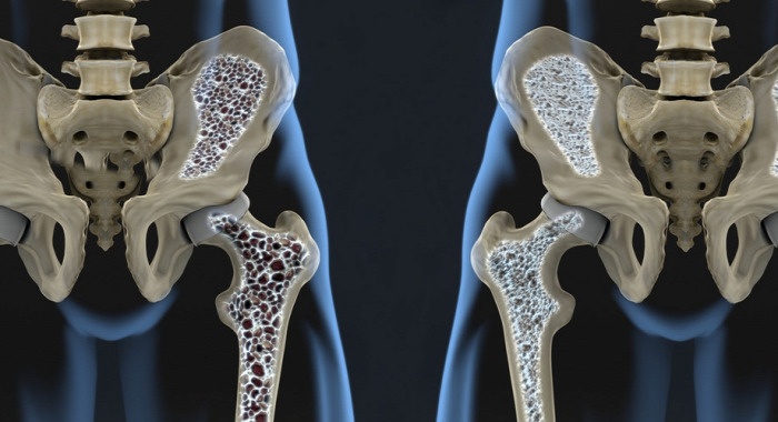 csontritkulás oseoporosis csontsűrűségmérés megelőzés terápia egészség