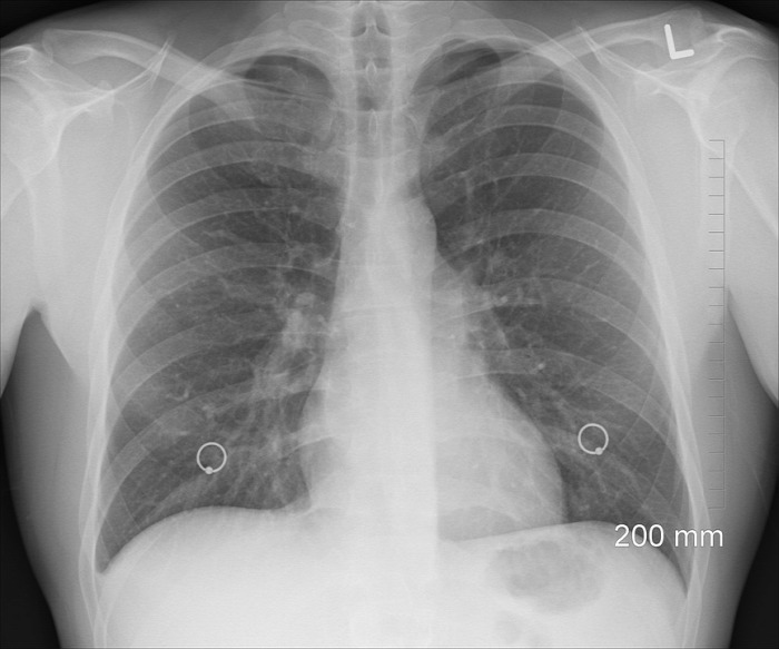 COPD tüdő egészség