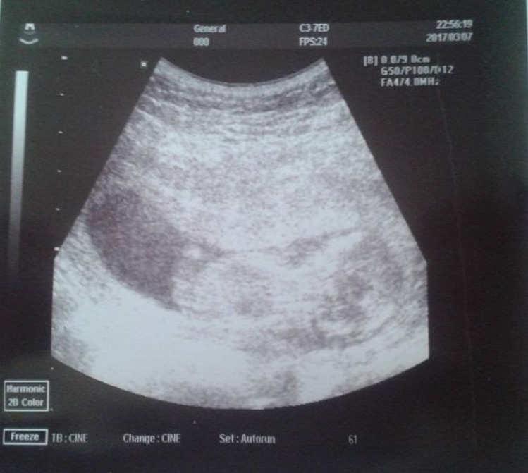 Gitta terhesnapló terhesség kismama ultrahang