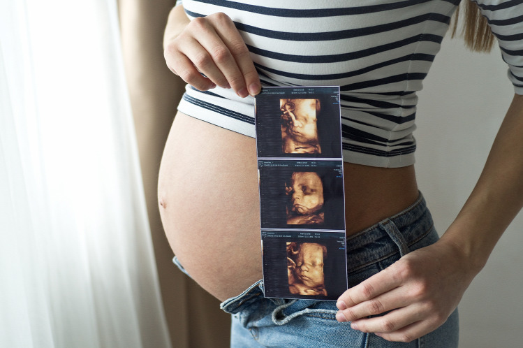 terhesség hármasikrek