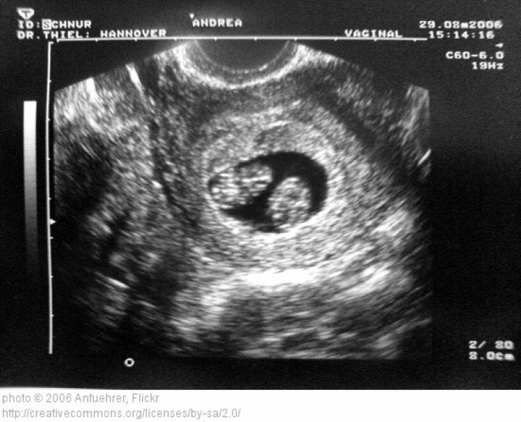 Zsani terhesség ikrek abortusz