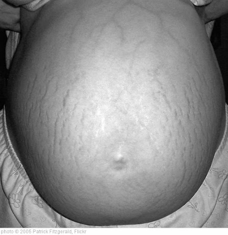 pitzur terhesség kismama