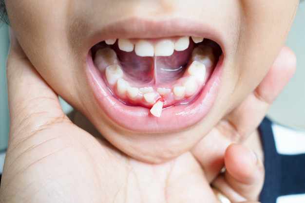 ferdén nő a gyerek foga 2020