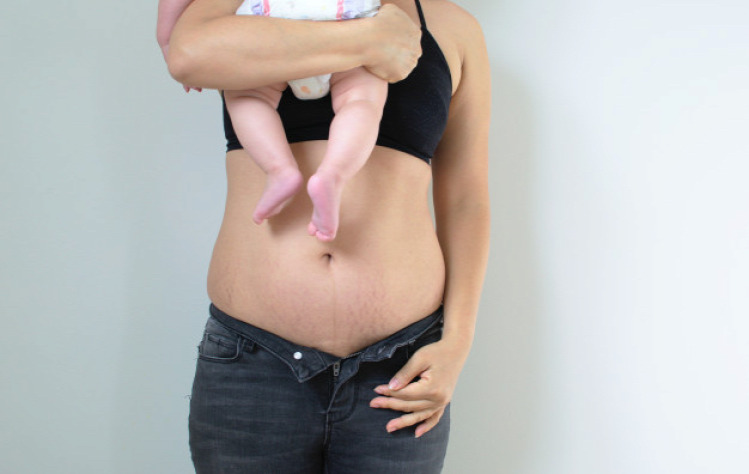 Vakmacska túlsúly fogyókúra terhesség kismama halál