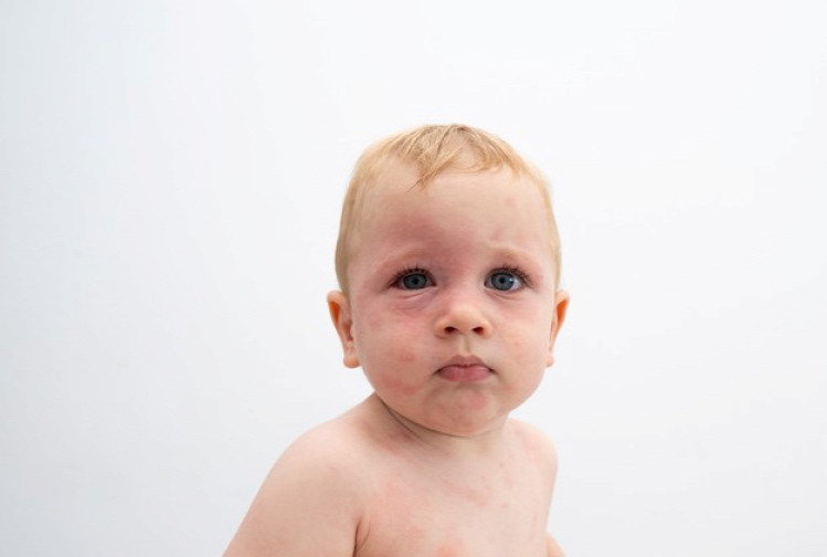 Aliena allergia betegség gyerek gyerekorvos