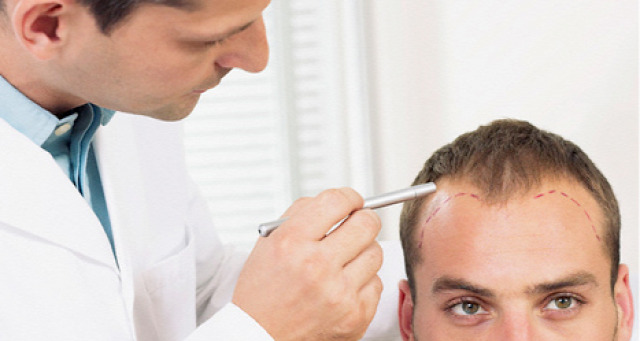 hajhullás kopaszodás hairhungary hairhungary klinika hajátültetés hajbeültetés kedvezmény kedvezményprogram részletfizetés egészséghitel tavasz árzuhanás